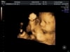 Baby 3D ultrasound image at Living Images in Shalimar near Fort Walton Beach
