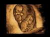 Twins at 11 weeks 3D ultrasound at Living Images near Fort Walton Beach