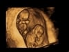 Twins ultrasound gallery image at Living Images near Fort Walton Beach